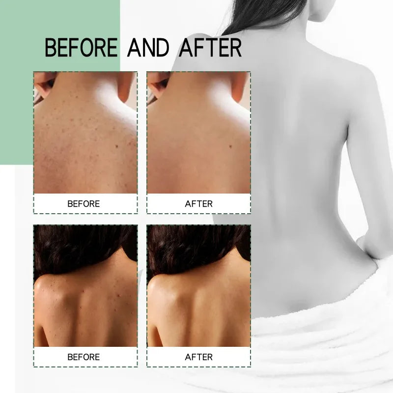 Acne Spray