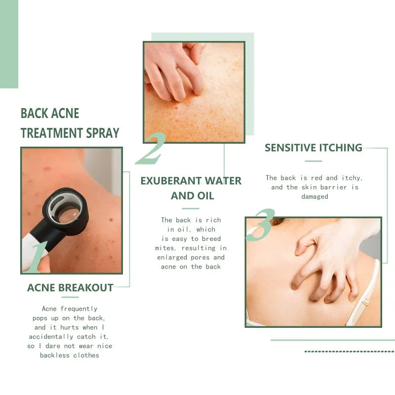 Acne Spray