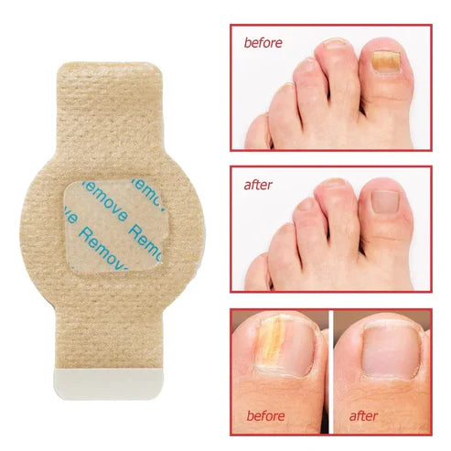 #1 Fungal Nail Patches